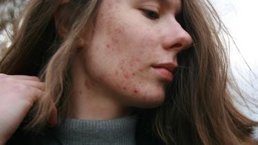 ontstekingen door acne
