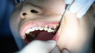 Beugel voor je kind: de orthodontievergoeding tot 18 jaar