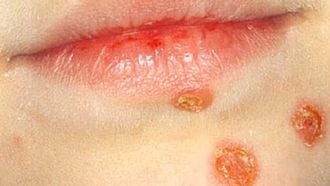 Impetigo