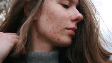 verzorgen acne