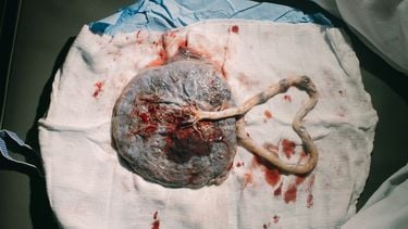 placenta operatief verwijderen